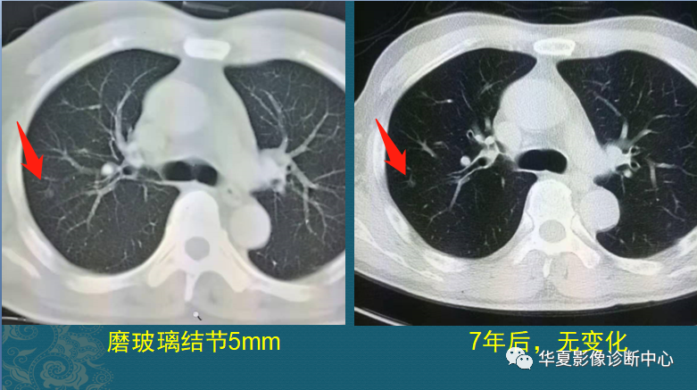 新冠后时代，九个里有十个出现肺结节的观察与思考